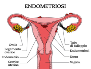 endometriosi